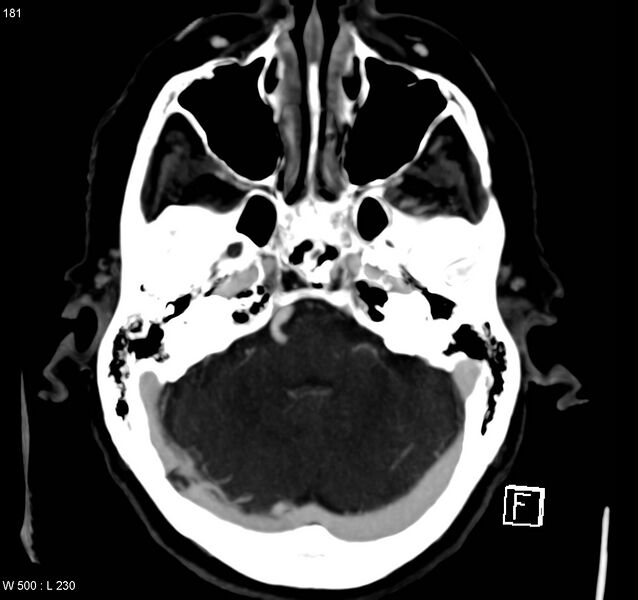 File:Arteriovenous malformation - cerebral (Radiopaedia 8172-14682 A 3).jpg