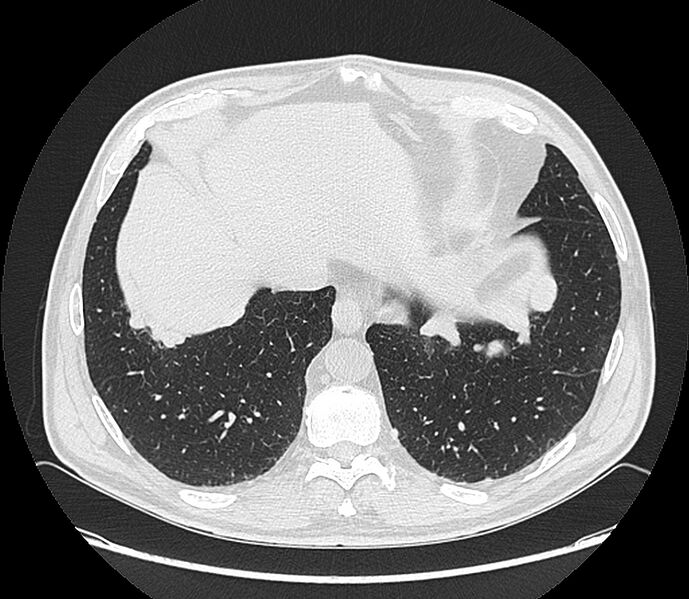 File:Asbestos pleural placques (Radiopaedia 57905-64872 Axial lung window 193).jpg