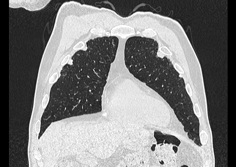 File:Asbestos pleural placques (Radiopaedia 57905-64872 Coronal lung window 51).jpg