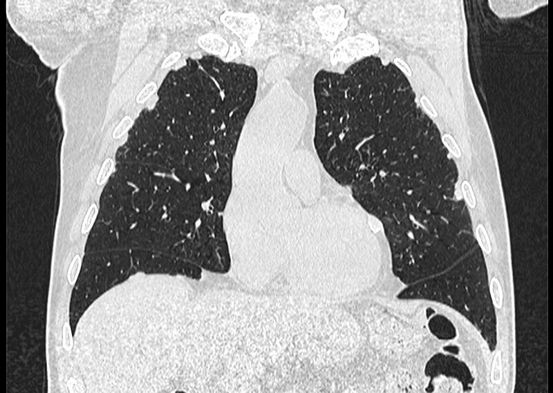 File:Asbestos pleural placques (Radiopaedia 57905-64872 Coronal lung window 97).jpg