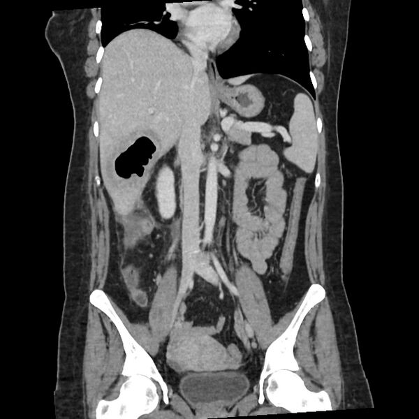 File:Ascending retrocecal appendicitis with liver abscesses (Radiopaedia 60066-67615 C 19).jpg