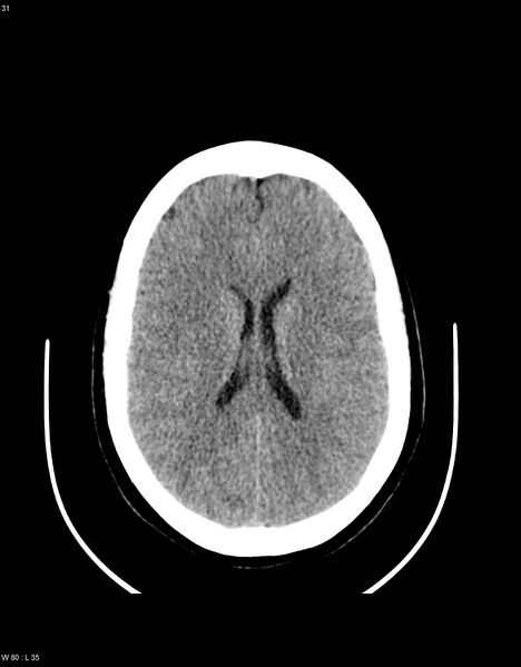 File:Astroblastoma (Radiopaedia 39792-42216 Axial non-contrast 30).jpg