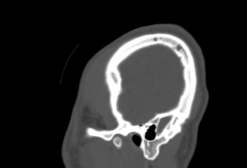 Asymptomatic occipital spur (Radiopaedia 87753-104201 Sagittal bone window 291).jpg