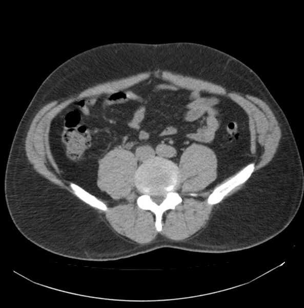 File:Atrophic kidney due to severe chronic obstructive hydronephrosis (Radiopaedia 40828-43474 Axial non-contrast 22).jpg