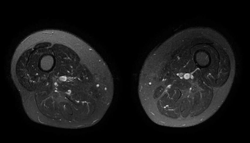 Atypical lipomatous tumor - thigh (Radiopaedia 68975-78734 Axial T2 fat sat 39).jpg