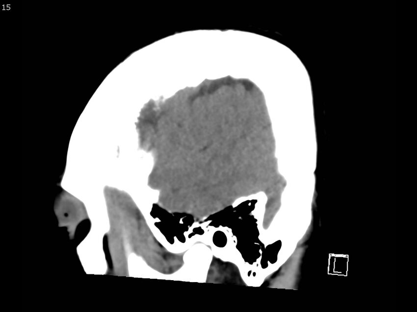Atypical meningioma - intraosseous (Radiopaedia 64915-73867 C 13).jpg