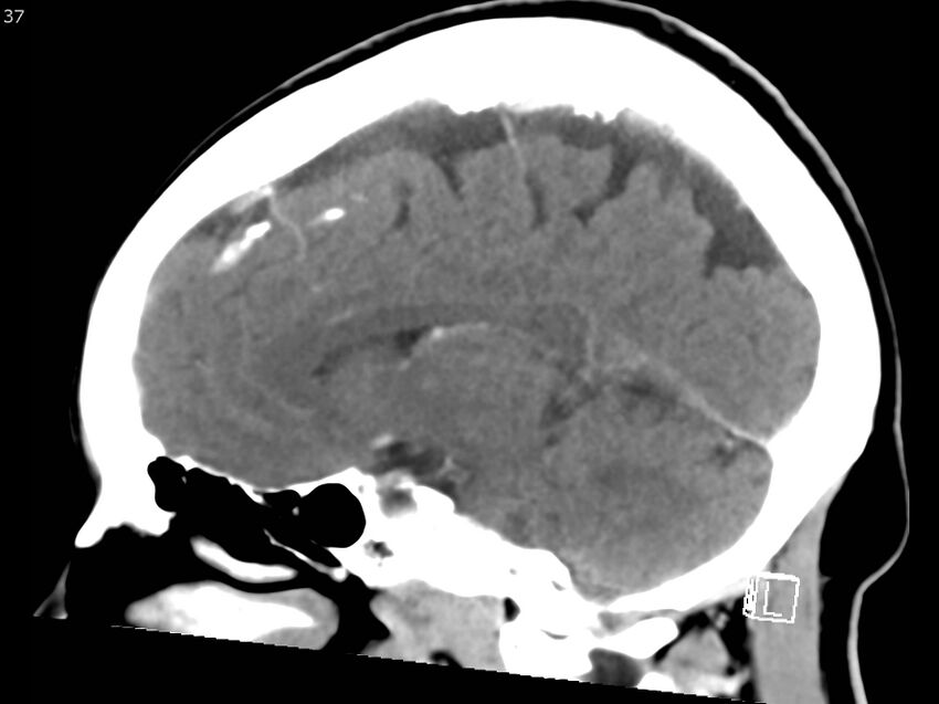 Atypical meningioma - intraosseous (Radiopaedia 64915-73867 F 36).jpg