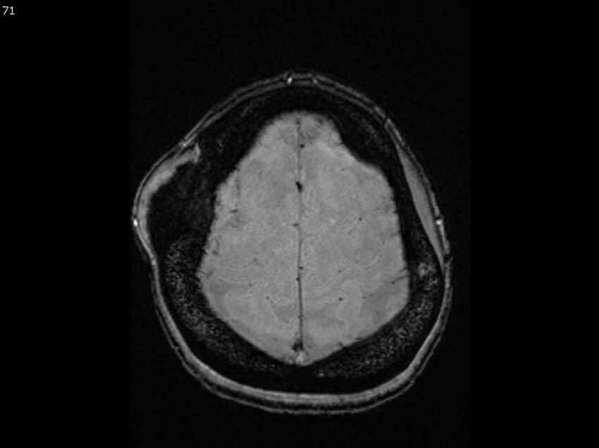 Atypical meningioma - intraosseous (Radiopaedia 64915-74572 Axial SWI 71).jpg