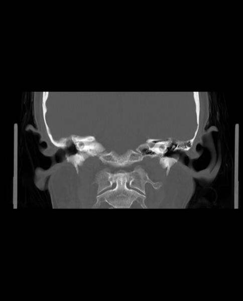 File:Automastoidectomy with labyrinthine fistula (Radiopaedia 84143-99411 Coronal non-contrast 93).jpg