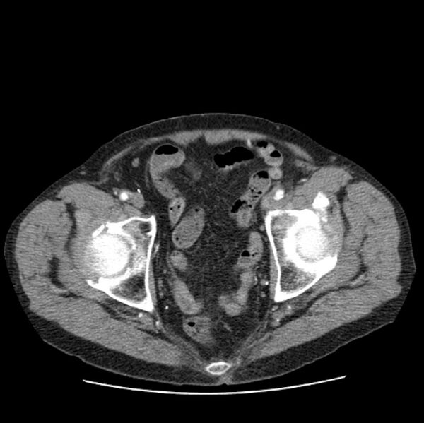 File:Autosomal dominant polycystic kidney disease (Radiopaedia 27851-28094 B 112).jpg
