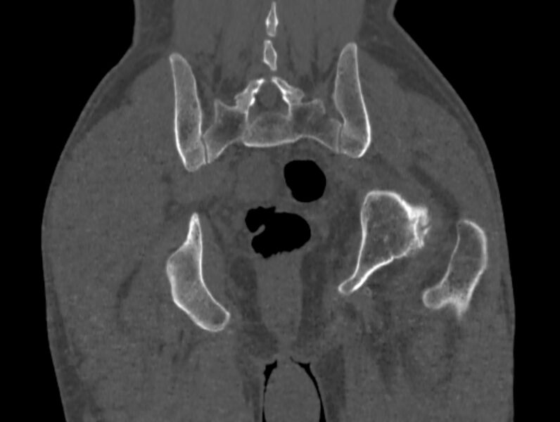File:Avascular necrosis of the left hip (Radiopaedia 75068-86125 Coronal bone window 80).jpg