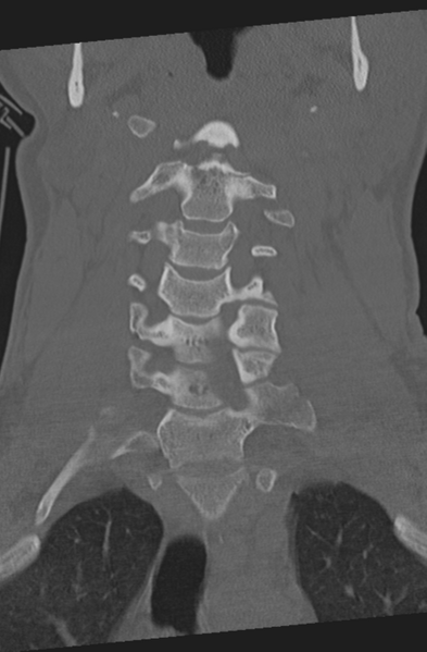 File:Axis peg fracture (type 3) and atlas lateral mass (type 4) fracture (Radiopaedia 37474-39324 Coronal bone window 16).png