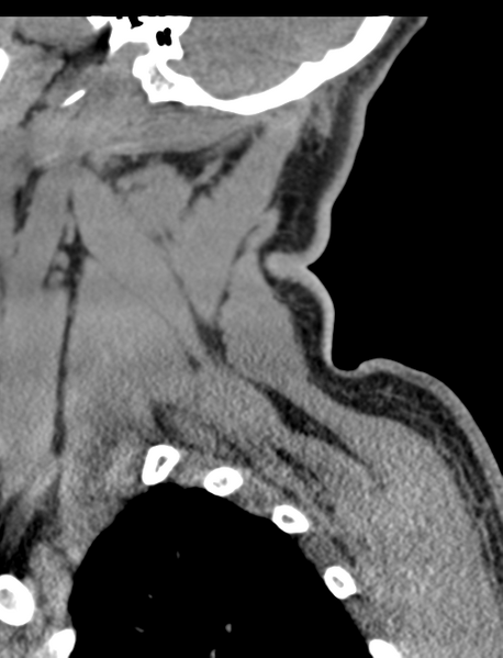 File:Axis peg fracture (type 3) and atlas lateral mass (type 4) fracture (Radiopaedia 37474-39324 D 8).png