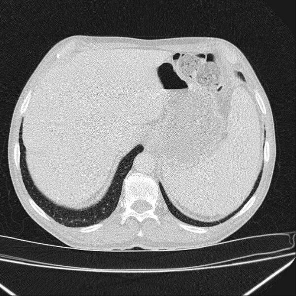 File:Azygos lobe (Radiopaedia 38259-40275 Axial lung window 75).jpg