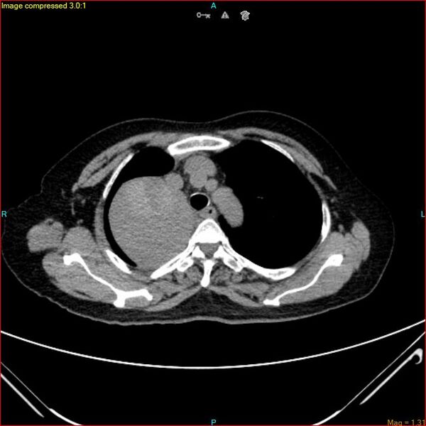 File:Azygos vein aneurysm (Radiopaedia 77824-90130 A 16).jpg