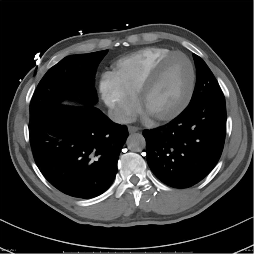 Azygos venous system anatomy (CT pulmonary angiography) (Radiopaedia 25928-26077 Axial C+ CTPA 65).jpg