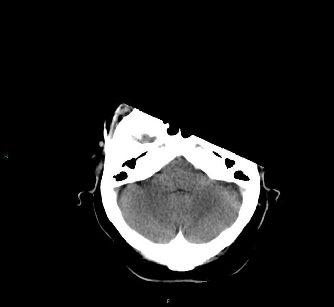 File:Basal ganglia hemorrhage (Radiopaedia 58759-65981 Axial non-contrast 40).jpg