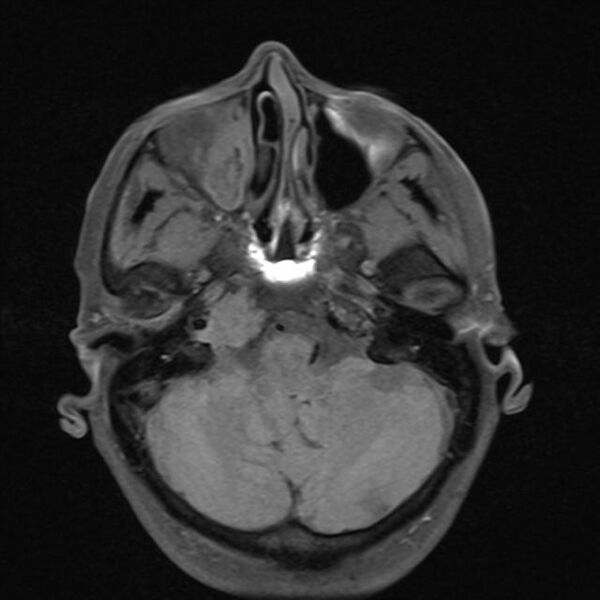 File:Base of skull chondrosarcoma (Radiopaedia 30410-31070 Axial T1 fat sat 7).jpg