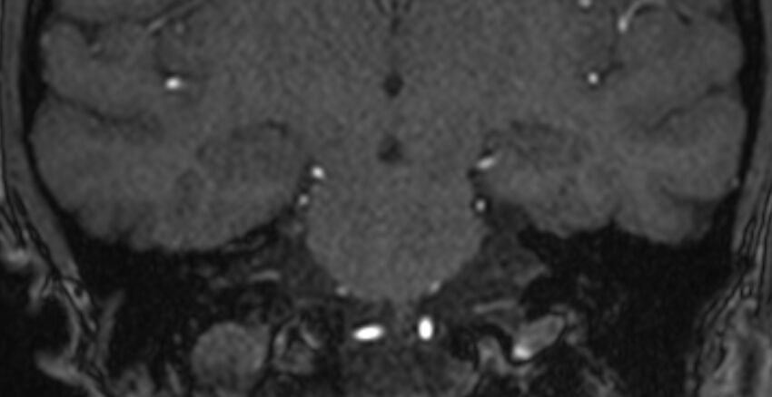 Basilar artery fenestration (Radiopaedia 74537-85455 Coronal MRA TOF 66).jpg