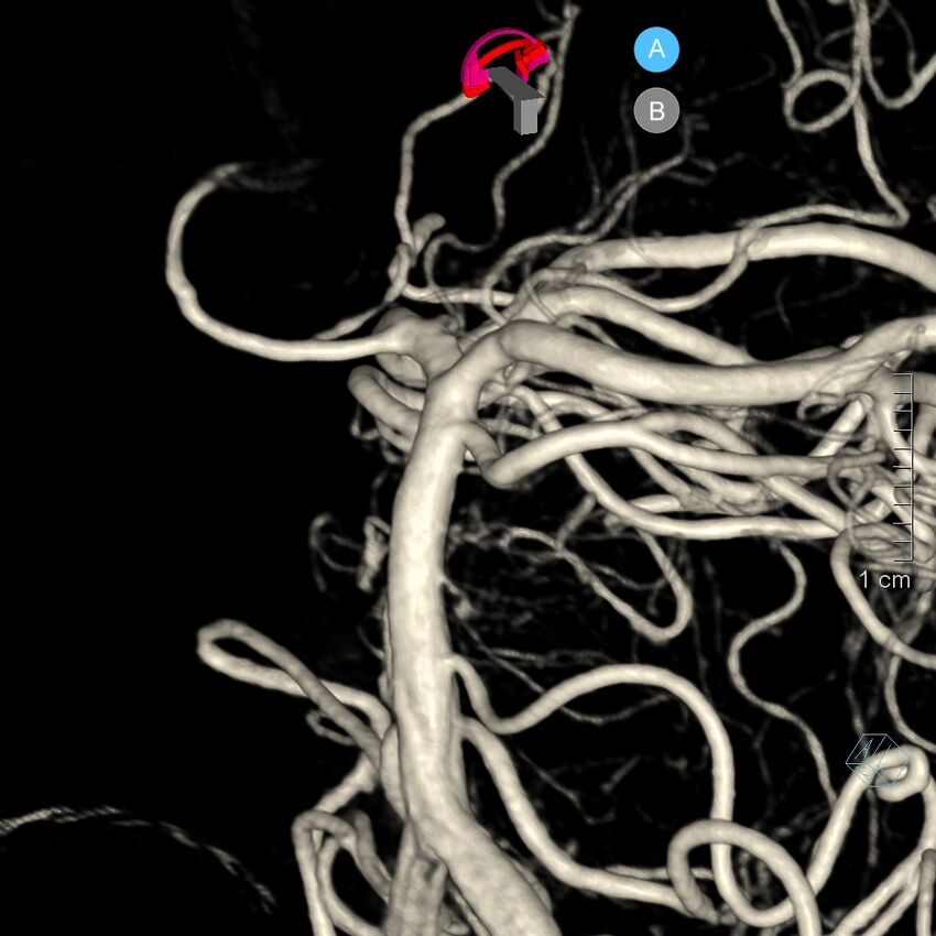 Basilar artery perforator aneurysm (Radiopaedia 82455-97734 3D view left VA 101).jpg