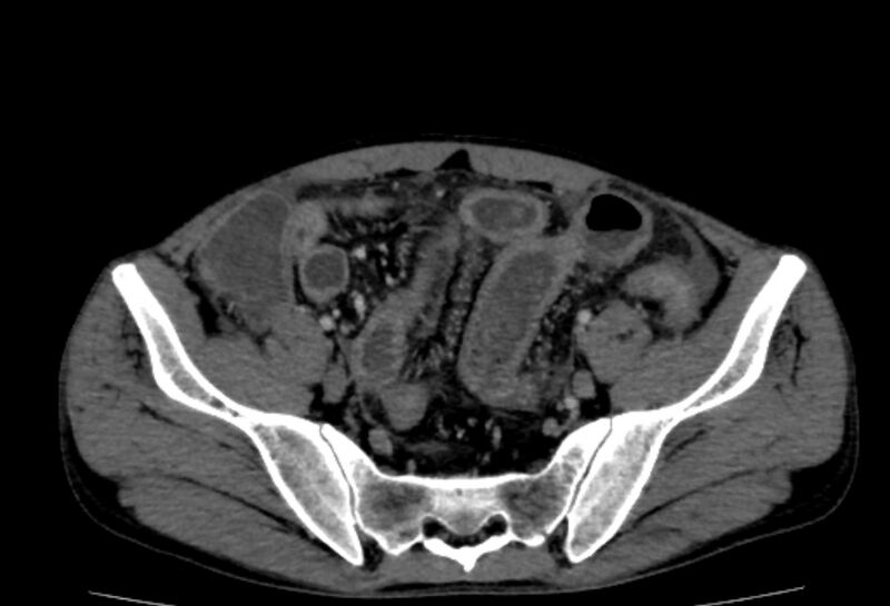 File:Behçet's disease- abdominal vasculitis (Radiopaedia 55955-62570 A 71).jpg