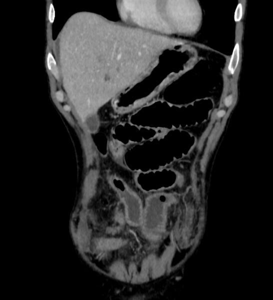 File:Behçet's disease- abdominal vasculitis (Radiopaedia 55955-62570 B 6).jpg