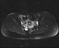 Bicornuate bicollis uterus (Radiopaedia 61626-69616 Axial PD fat sat 19).jpg