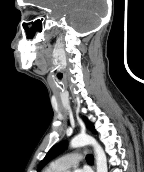 File:Bilateral carotid body tumors (Radiopaedia 52899-58827 C 35).jpg