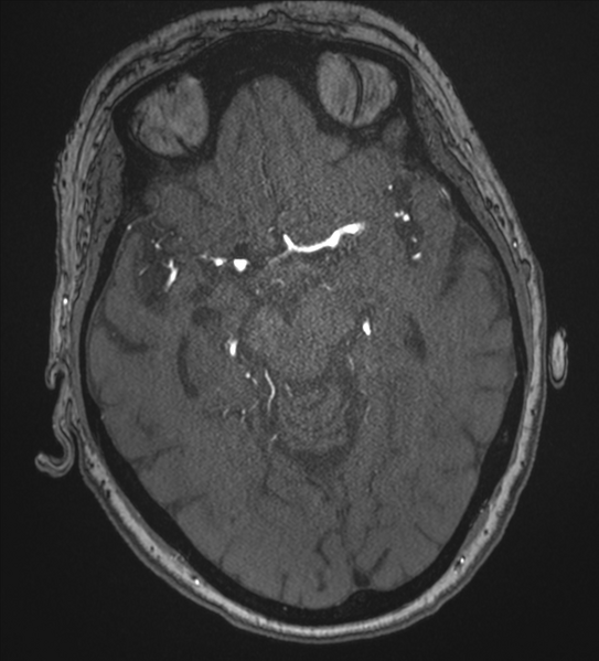File:Bilateral fetal posterior communicating arteries (Radiopaedia 41286-44102 Axial MRA 87).png