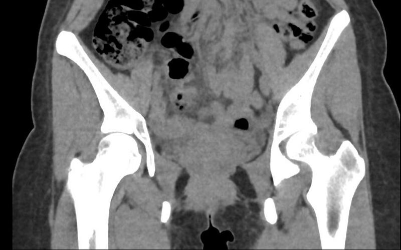 File:Bilateral mature cystic ovarian teratoma (Radiopaedia 88821-105592 Coronal non-contrast 6).jpg