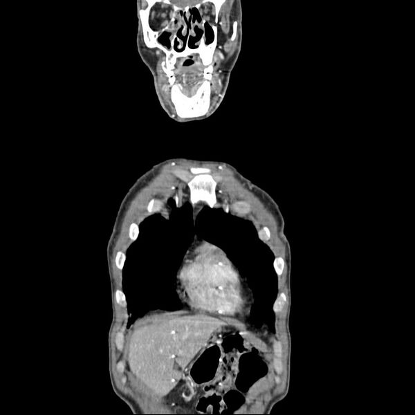 File:Bilateral parotid gland lymphoma (Radiopaedia 21038-20969 B 3).jpg