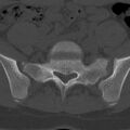 Bilateral pars defect (Radiopaedia 26691-26846 Axial bone window 74).jpg