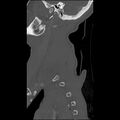 Bilateral perched facets with cord injury (Radiopaedia 45587-49713 Sagittal bone window 3).jpg
