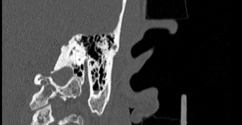 File:Bilateral temporal bone fractures (Radiopaedia 29482-29970 B 60).jpg