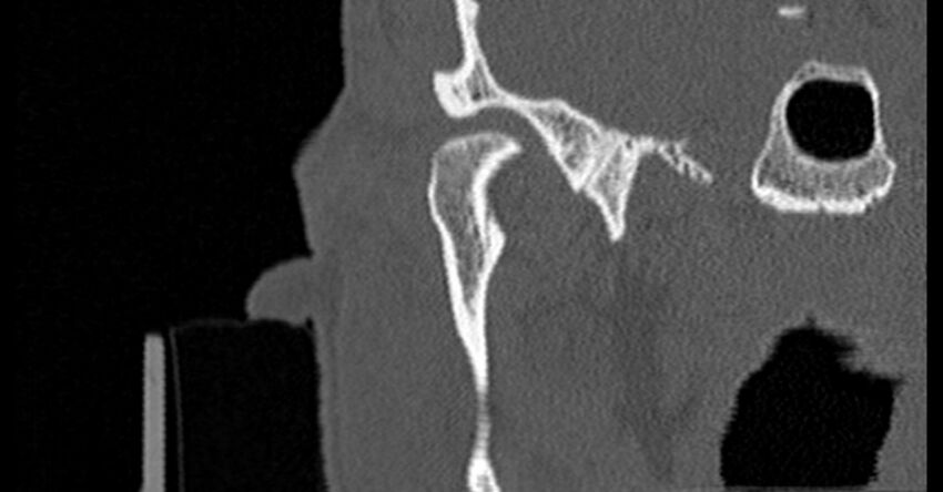 Bilateral temporal bone fractures (Radiopaedia 29482-29970 Coronal non-contrast 42).jpg