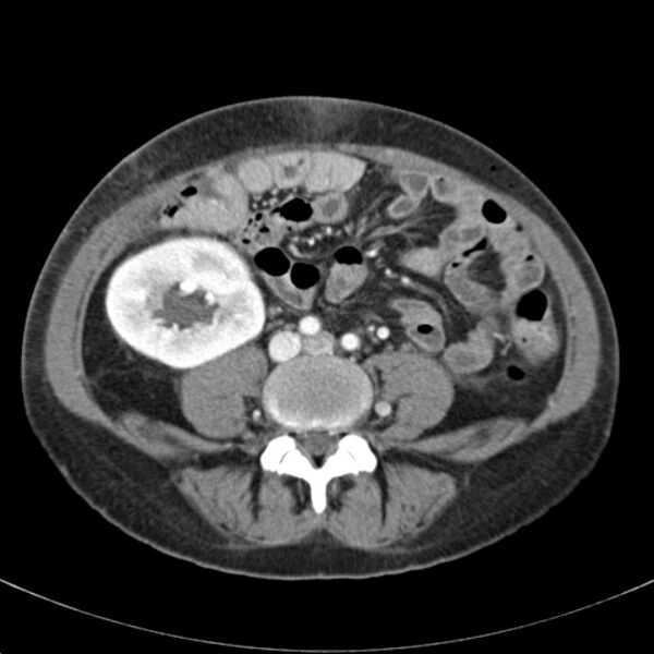 File:Biliary necrosis - liver transplant (Radiopaedia 21876-21846 B 49).jpg