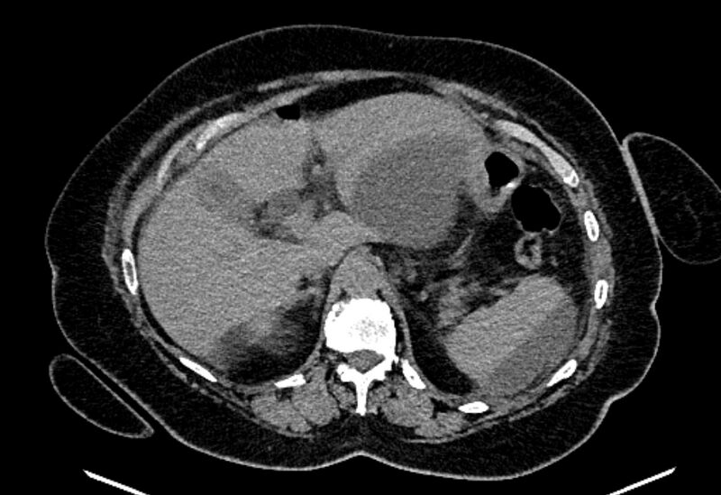 File:Biliary pancreatitis (Radiopaedia 72289-82823 Axial non-contrast 82).jpg