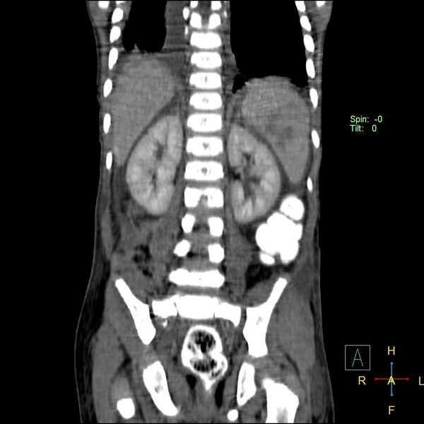 File:Blunt abdominal trauma (Radiopaedia 24780-25044 C 16).jpg