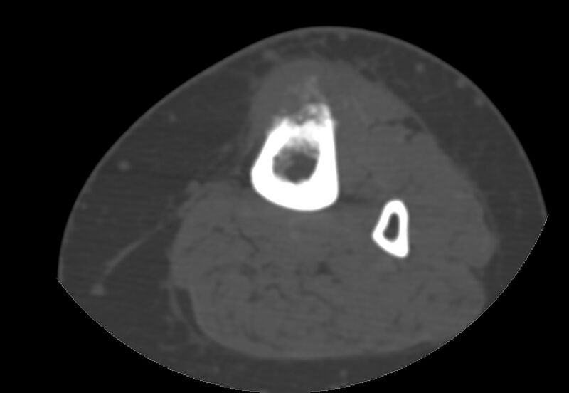 File:Bone metastasis - tibia (Radiopaedia 57665-64609 Axial bone window 89).jpg