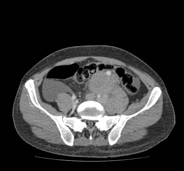 File:Bowel lymphoma complicated by bleeding after therapy (Radiopaedia 55601-62107 A 60).jpg