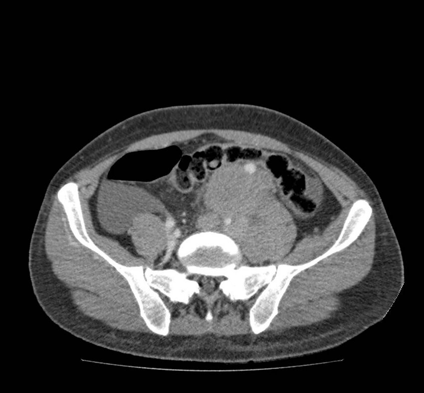 Bowel lymphoma complicated by bleeding after therapy (Radiopaedia 55601-62107 A 60).jpg