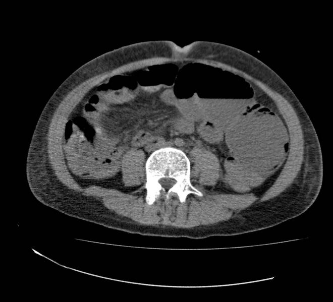 File:Bowel lymphoma complicated by bleeding after therapy (Radiopaedia 55601-62110 Axial non-contrast 49).jpg