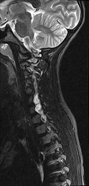 File:Brachial plexus birth palsy (Radiopaedia 68118-77604 Sagittal T2 5).jpg