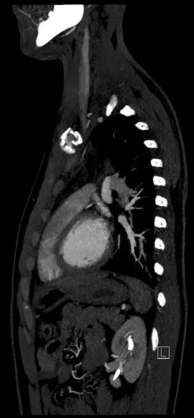 File:Brachiocephalic trunk pseudoaneurysm (Radiopaedia 70978-81191 C 64).jpg
