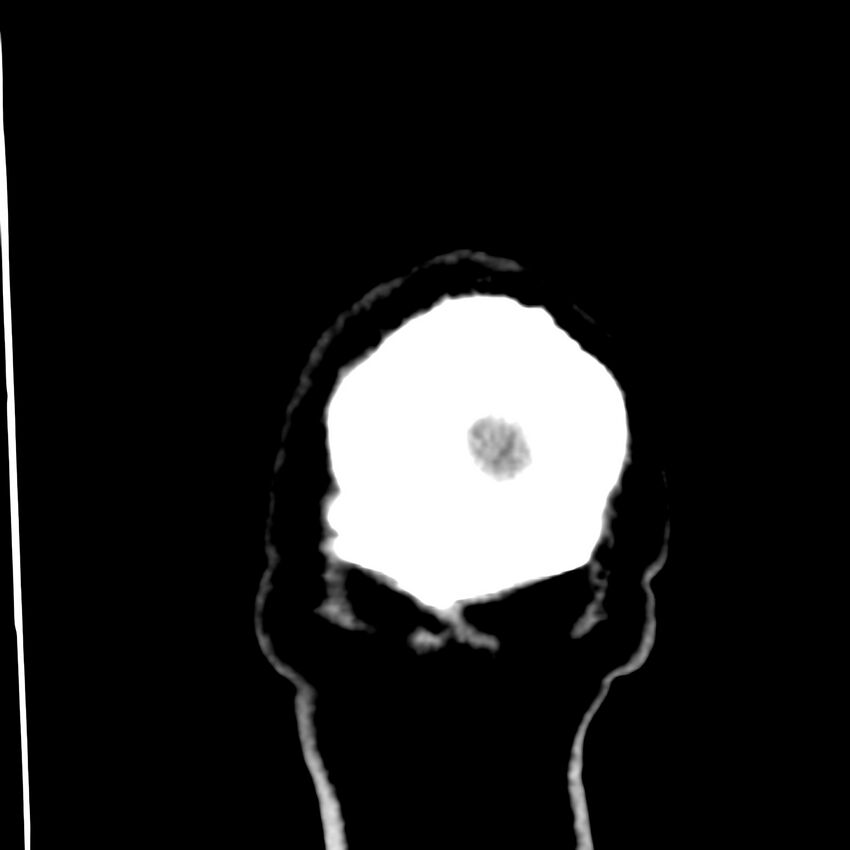Brain Pantopaque remnants (Radiopaedia 78403-91048 Coronal non-contrast 72).jpg