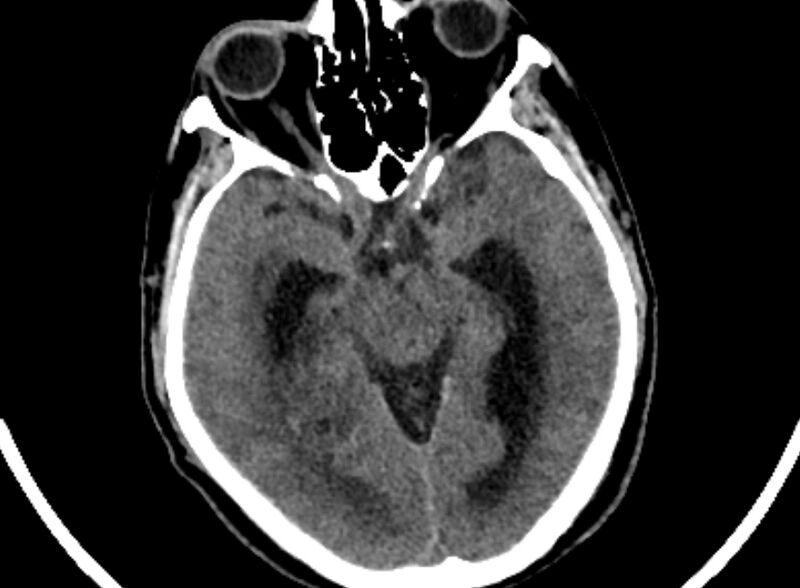File:Brain abscess complicated by intraventricular rupture and ventriculitis (Radiopaedia 82434-96575 Axial non-contrast 20).jpg