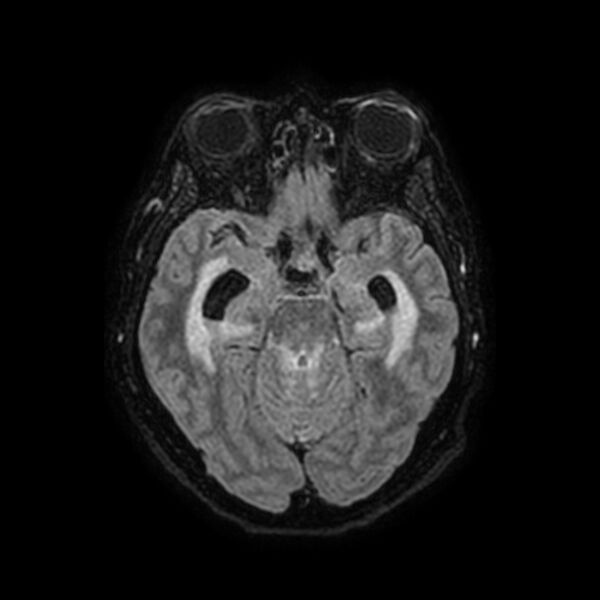 File:Brain abscess complicated by intraventricular rupture and ventriculitis (Radiopaedia 82434-96577 Axial FLAIR 22).jpg