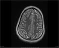 Brainstem glioma (Radiopaedia 21819-21775 Axial T2 30).jpg