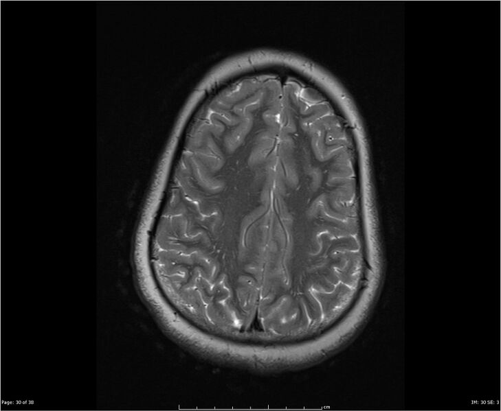 File:Brainstem glioma (Radiopaedia 21819-21775 Axial T2 30).jpg