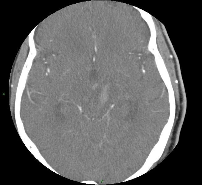 File:Brainstem hemorrhage (Radiopaedia 58794-66028 D 87).jpg